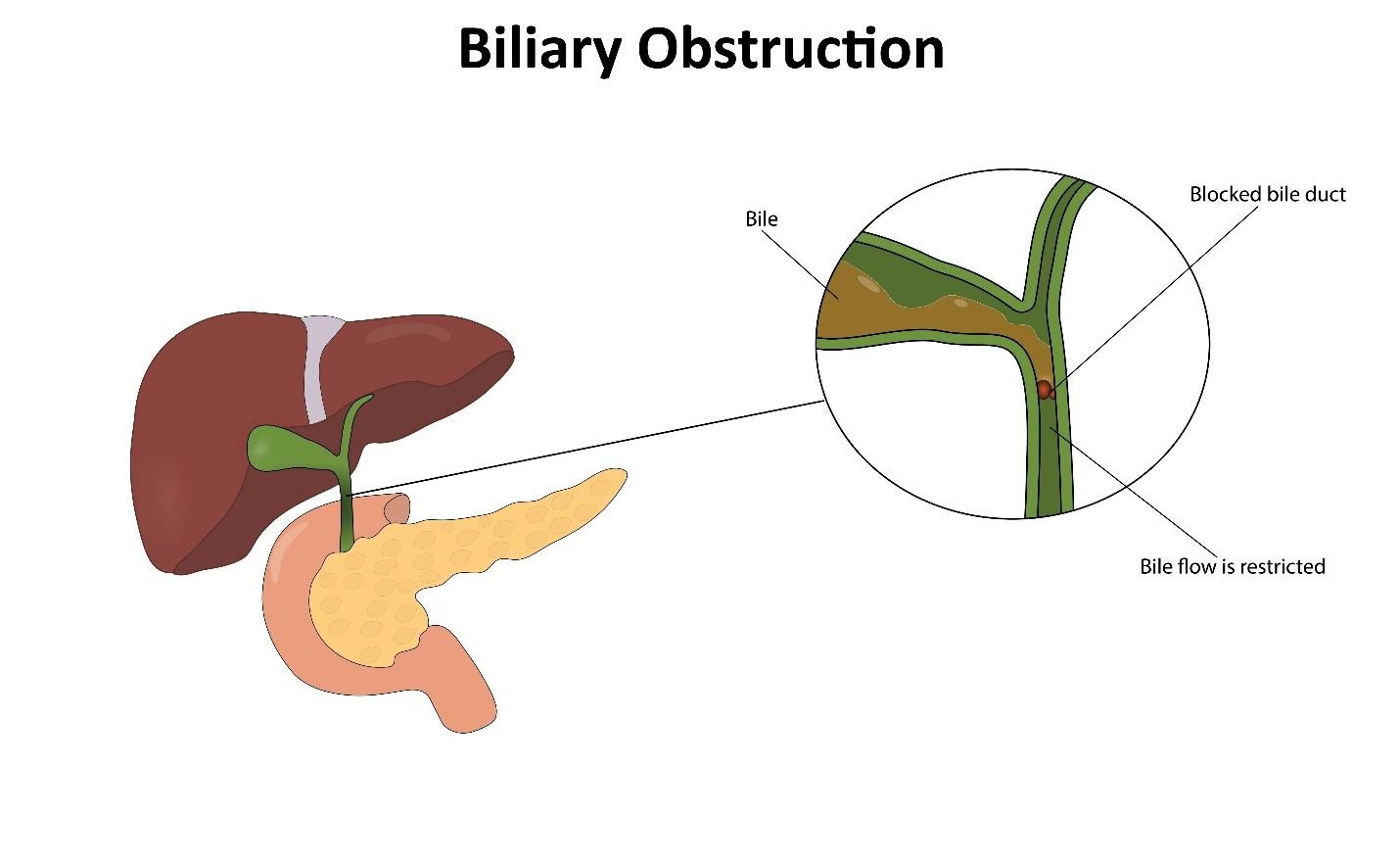 complications of gallstones, including cholecystitis, jaundice and pancreatitis.
