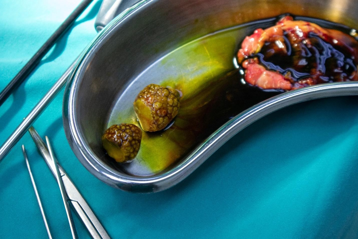gallstone treatment and gallbladder surgery Singapore